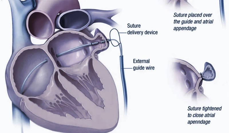 Left atrial appendage closure (laa)