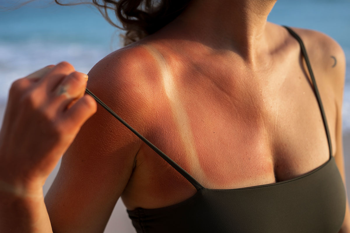 Coup de soleil