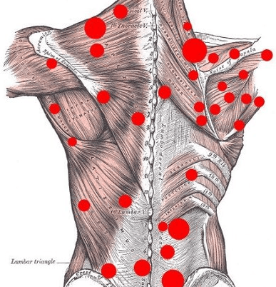 trigger points, acupuncture, acupressure