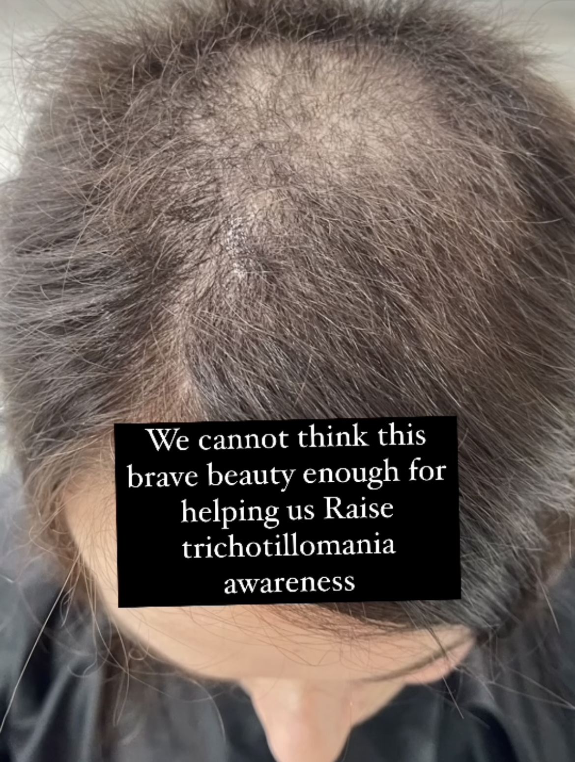 Trichotillomania hair regrowth: overcoming barriers boston