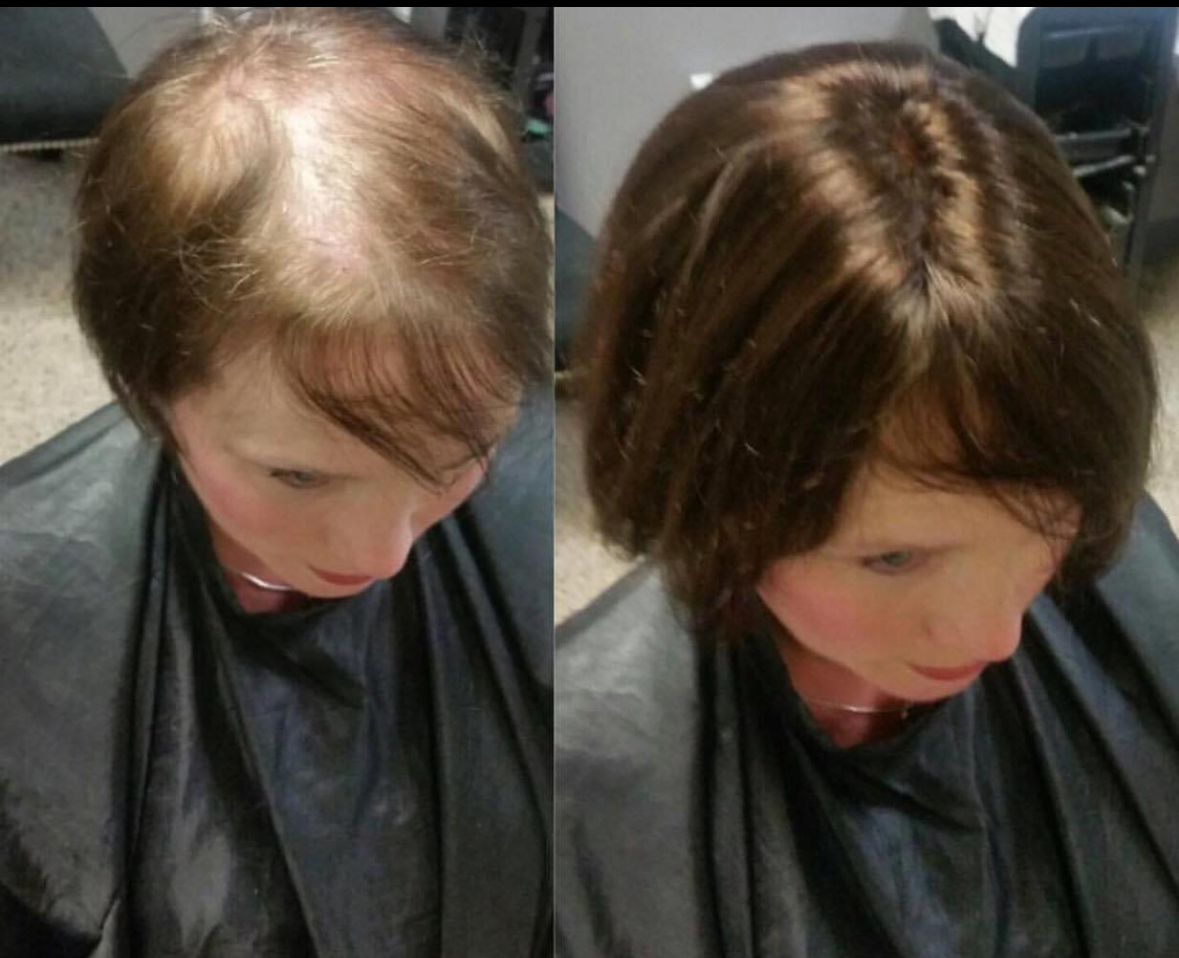 Trichotillomania hair regrowth: expert tips and strategies boston, mas