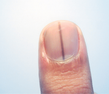 Normal black line under fingernail vs. melanoma streak