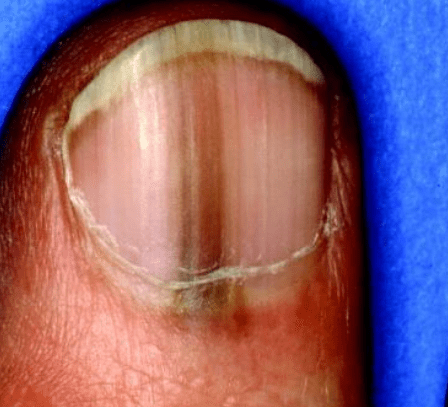 Normal black line under fingernail vs. melanoma streak