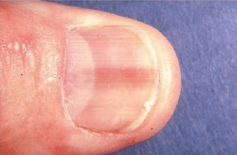 Pink line or stripe on fingernail or toenail can be melanoma