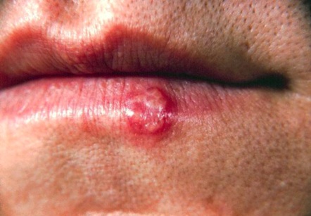They are caused by the common and highly . Is It True That Having Cold Sores Means You Ve Got Herpes In Your Mouth Scienceline
