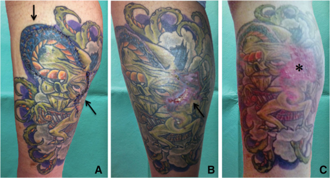 Tatuaggi: Quello Che Non Vi Hanno Mai Detto | Blog Di Igiene Naturale Ortopatia Di Stefano Torcellan 360_x_666_jpg