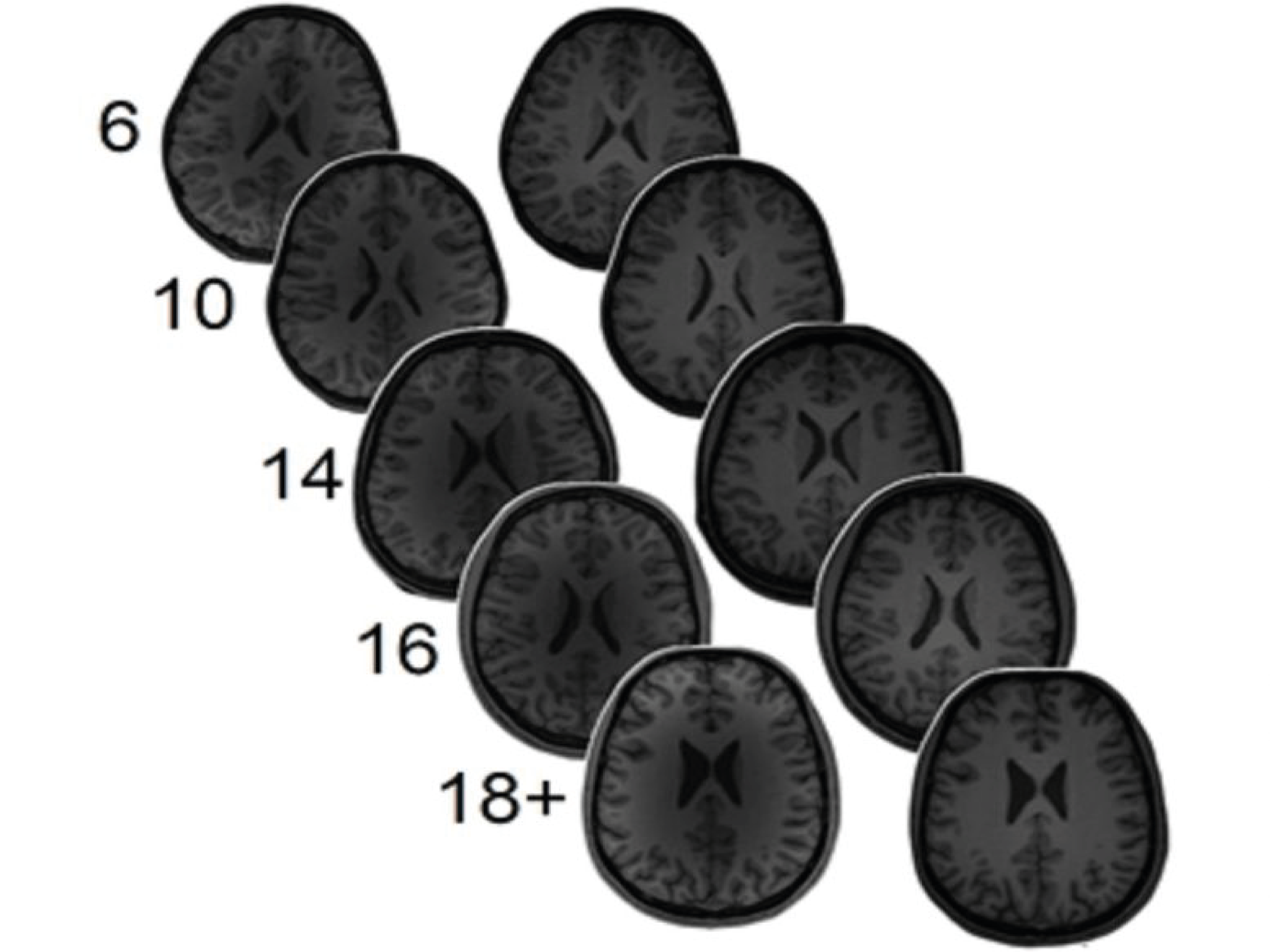 Neurotransmitter Levels in the Brain Can Predict Math Ability