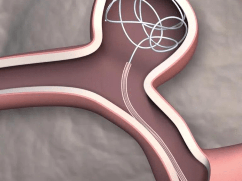 Insect-inspired catheter aids in navigating the brain’s intricate pathways
