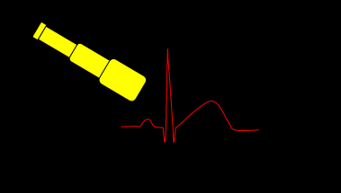 Recognizing a Subtle STEMI (Occlusion Myocardial Infarction)