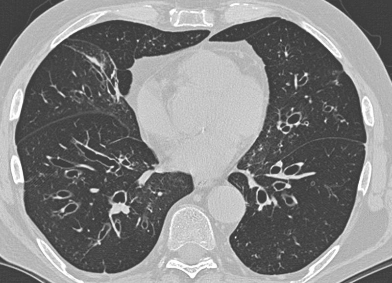 Bronchiectasis And A Shift Dress Seam