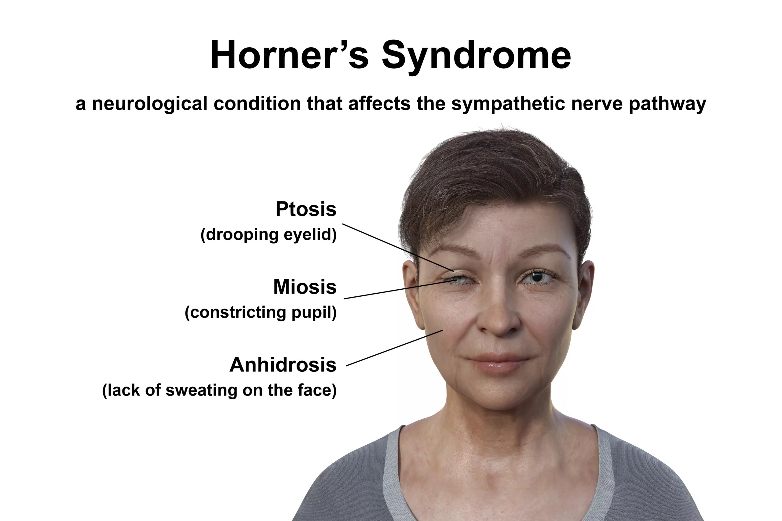 Horner's syndrome: causes, symptoms & treatment options