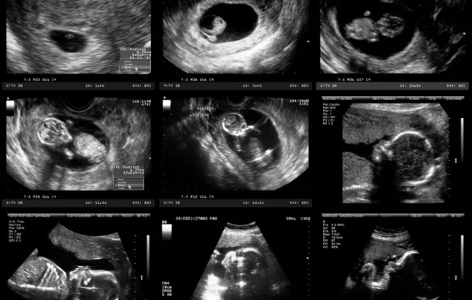 Grossesses tardives : nouvelle démographie ? 