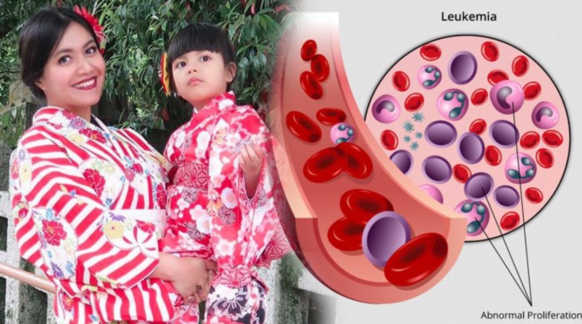 Biasanya mempengaruhi leukosit, atau sel darah putih. Ini Loh 5 Gejala Awal Leukimia Atau Kanker Darah Seruni Id