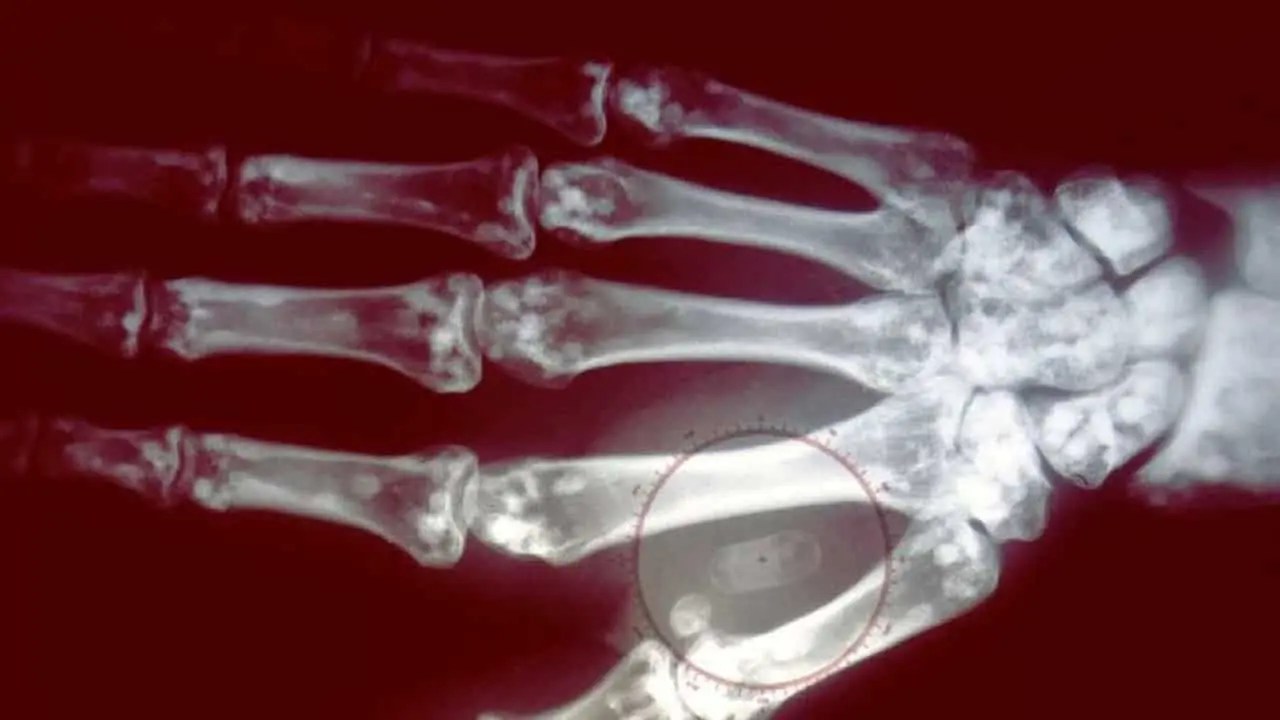 Milhares de usuários de cartão de crédito na Suécia implantam microchip na mão
