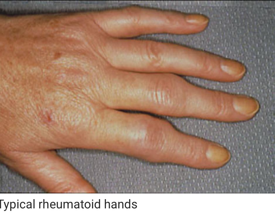 العوامل الوراثية والبيئية تلعب دورًا في تطور مرض التهاب المفاصل الروماتويدي