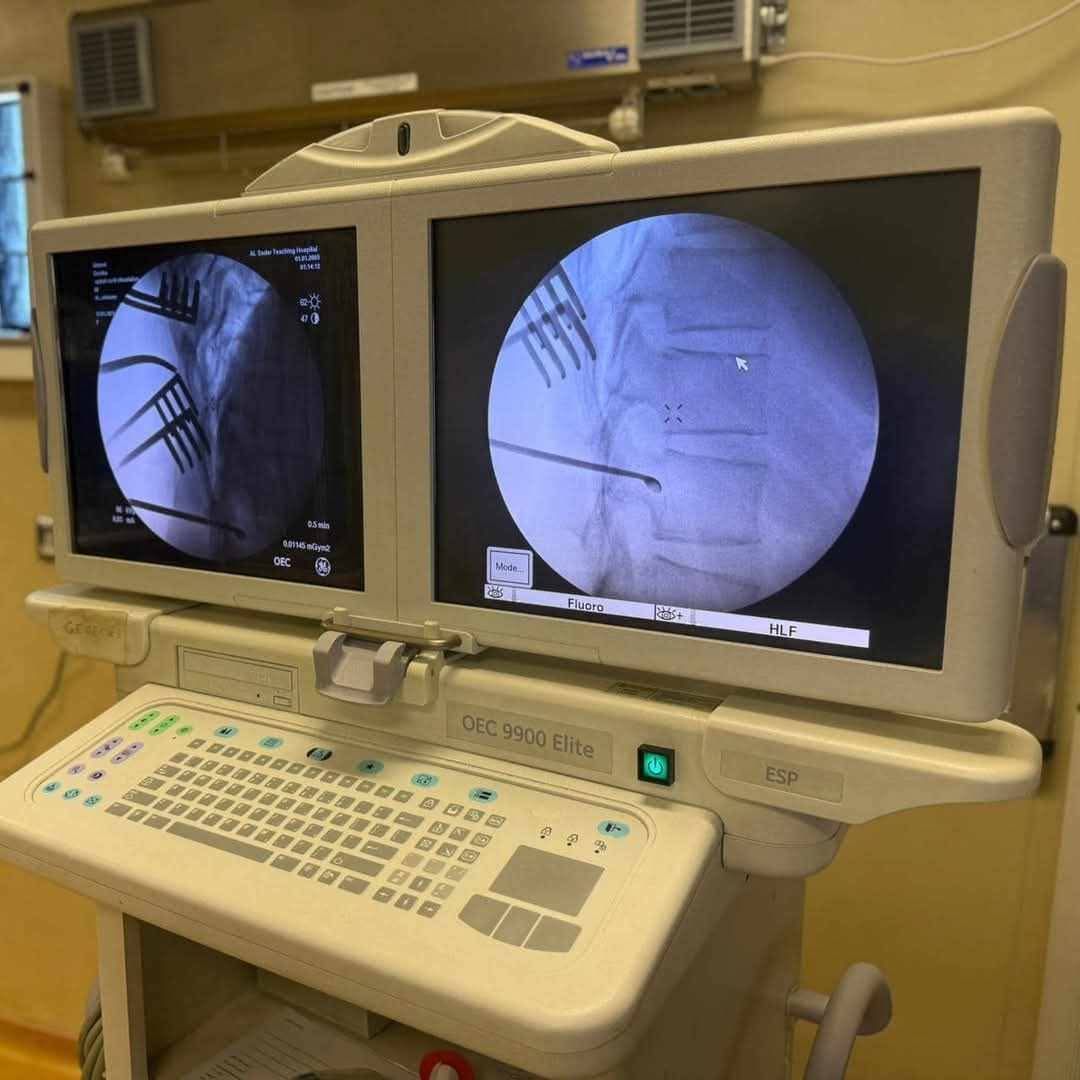فريق طبي ينجح بإجراء عملية زرع بطارية لتحفيز الحبل الشوكي