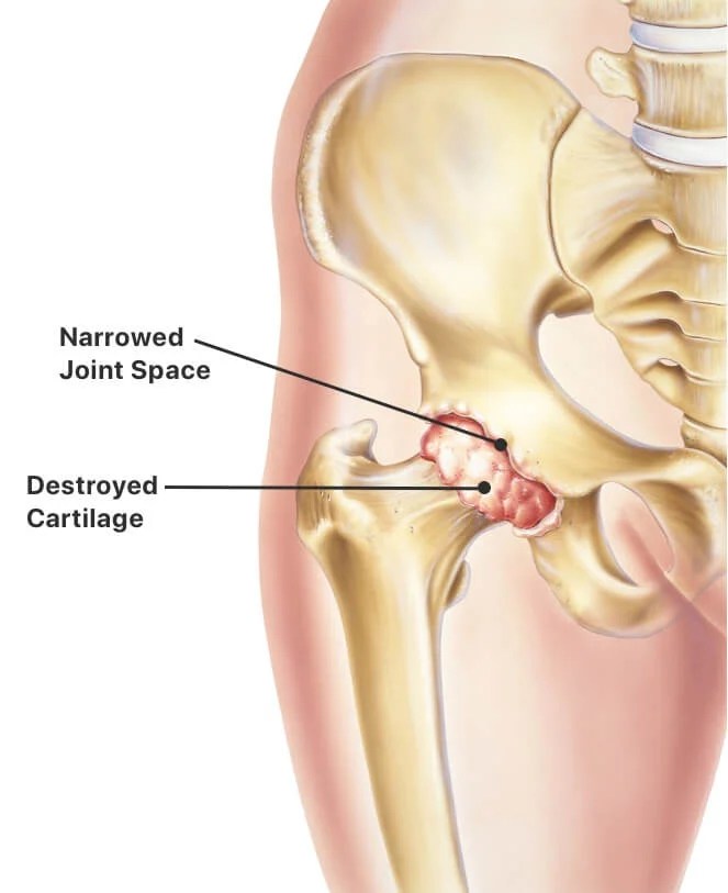 hip replacement