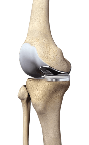 knee replacement