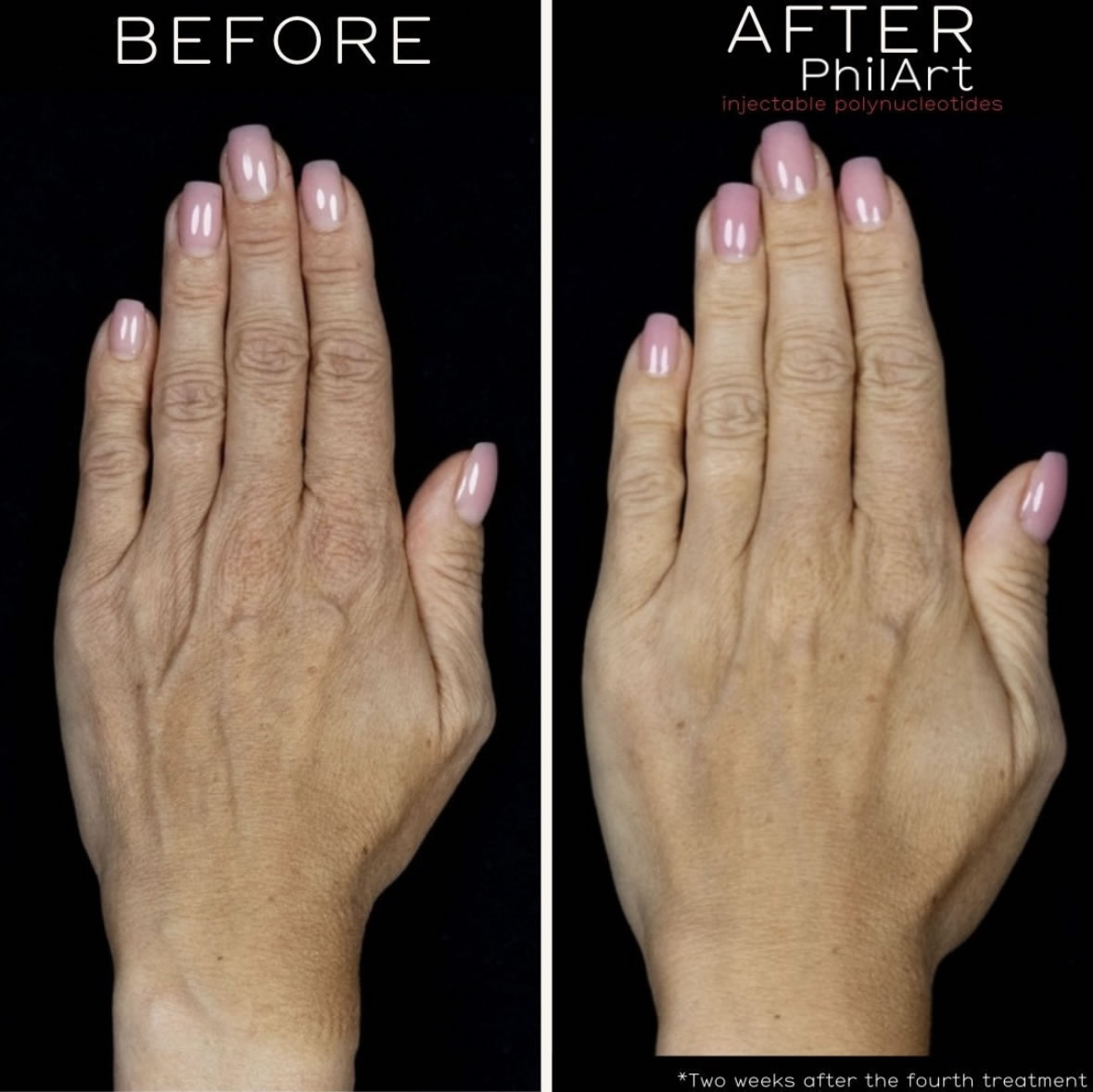 Polynucleotide Injections