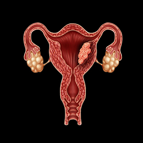 Endometrial Cancer – Early Detection