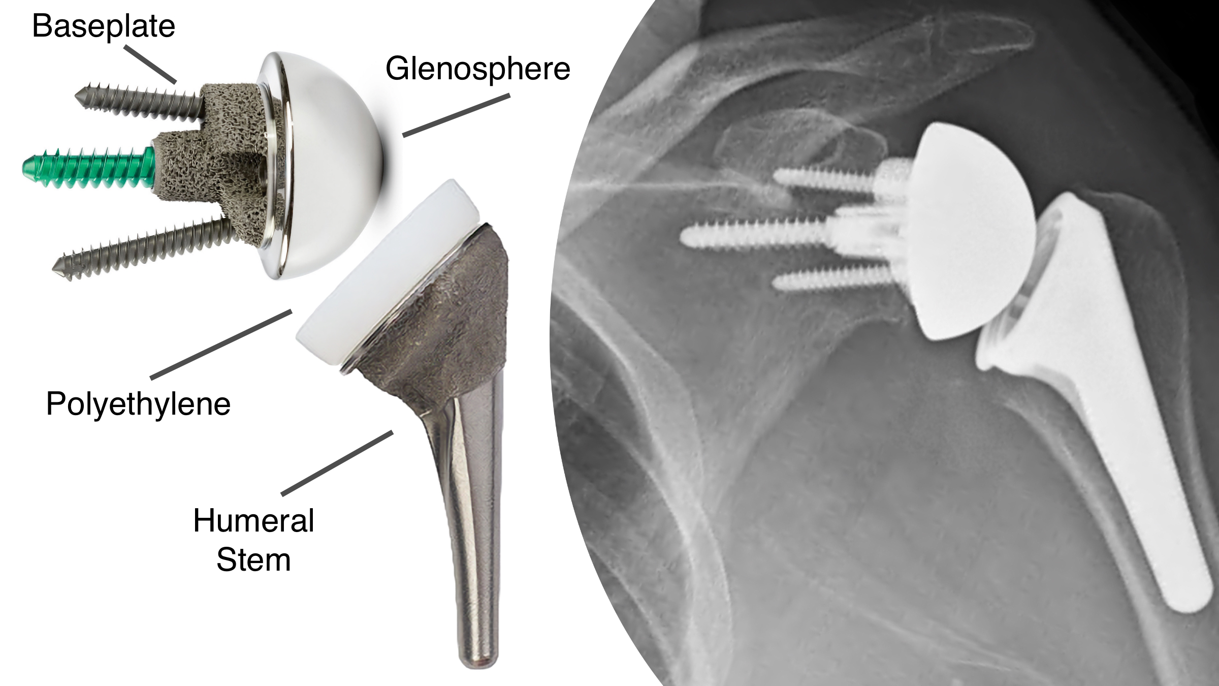 Robot-Assisted Reverse Shoulder Replacement - Shoulder & Elbow