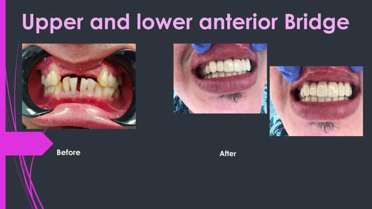before and after.pptx (1)