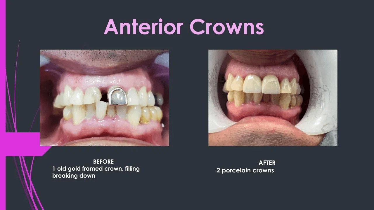 before and after12.pptx (10)