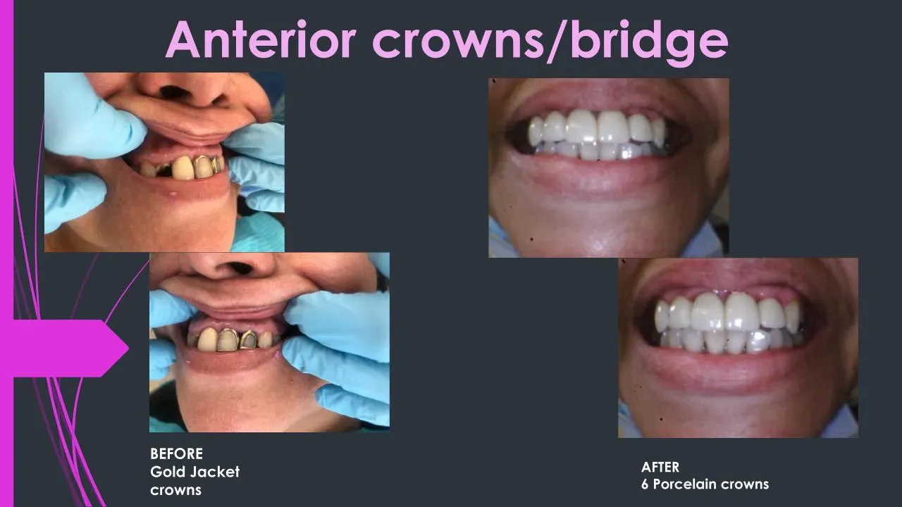 before and after4.pptx (2)
