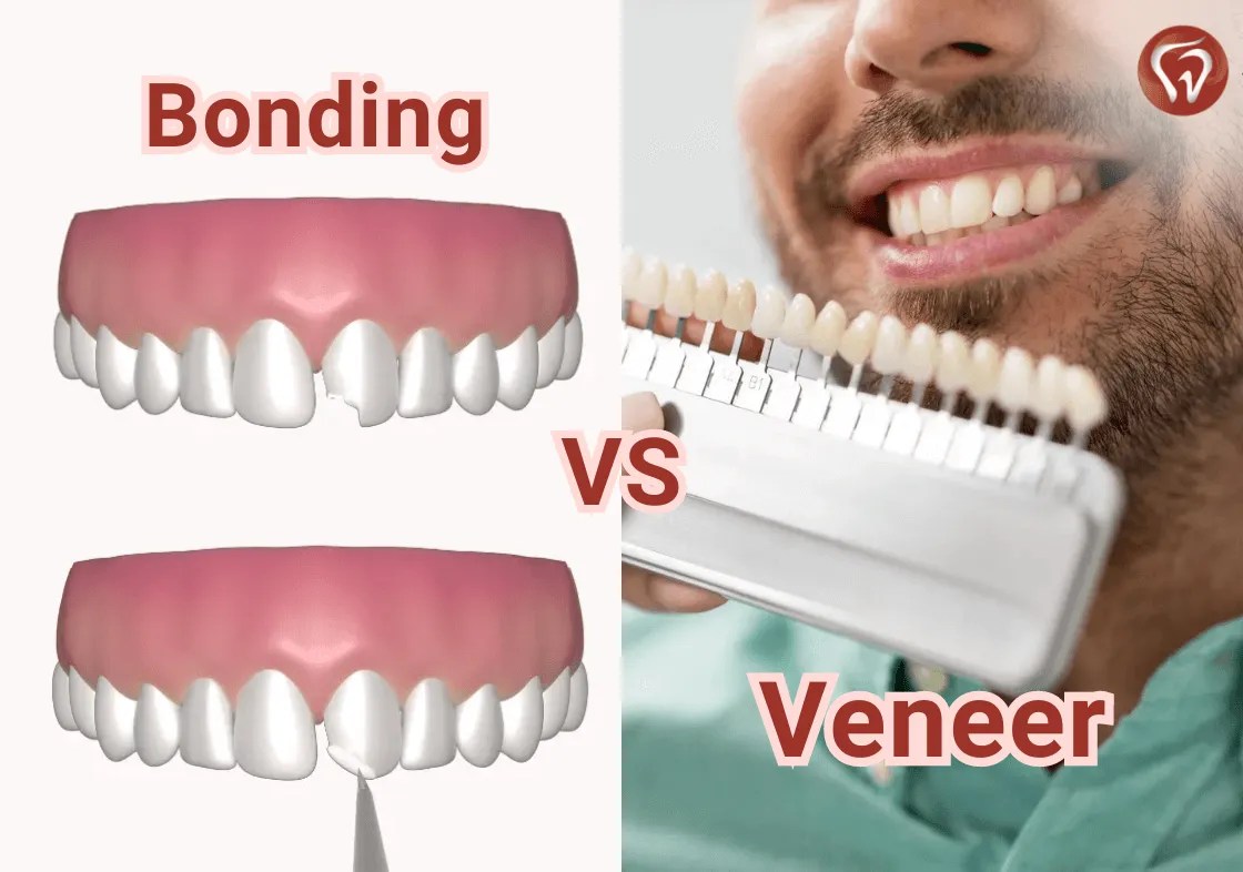 Bonding vs veneers: a comprehensive guide