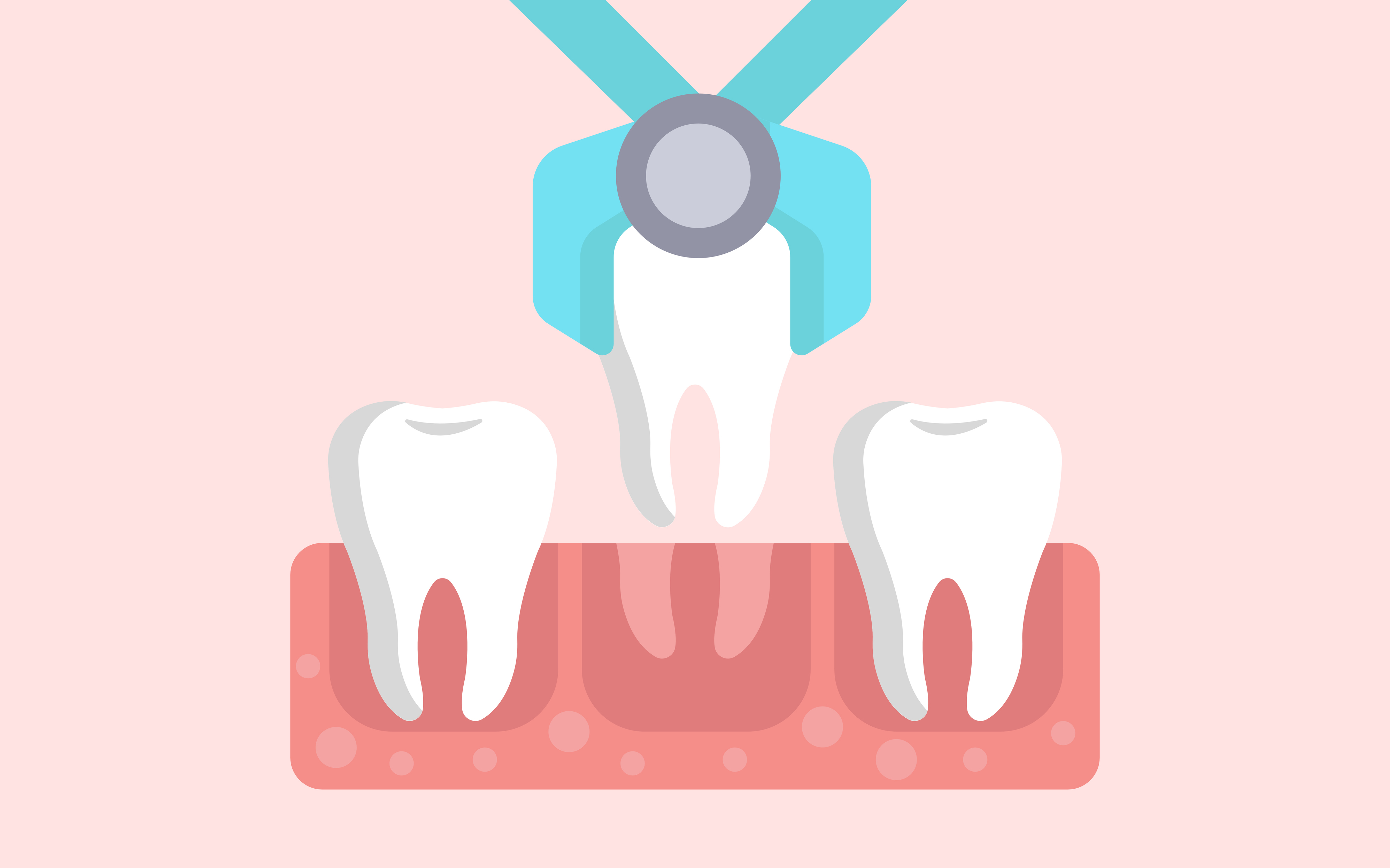Tooth Extraction - Illustration