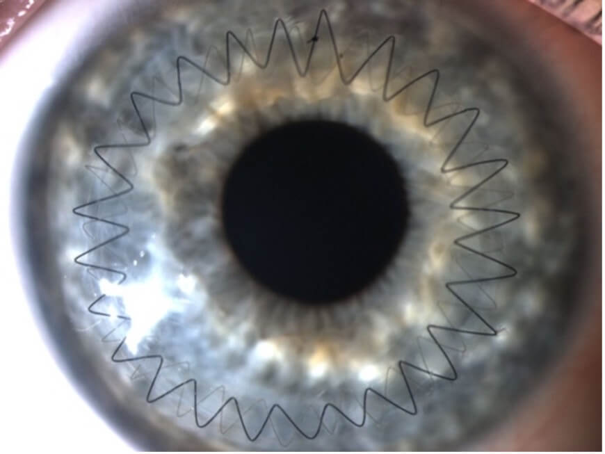 ICL Eye Surgery Machine Woodbridge VA