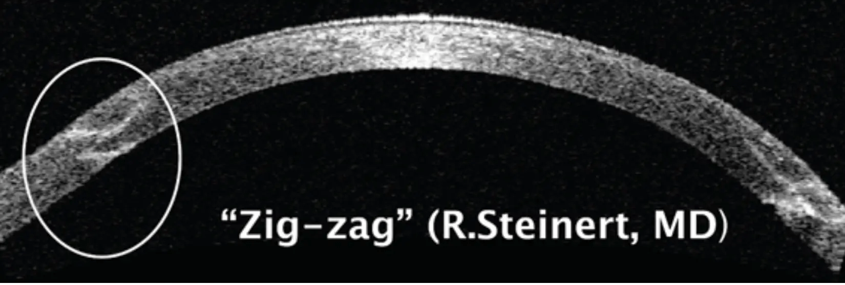 ICL Eye Surgery Woodbridge VA