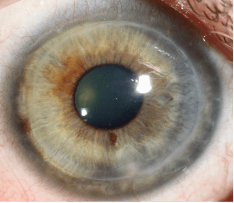 ICL Eye Surgery Machine Woodbridge