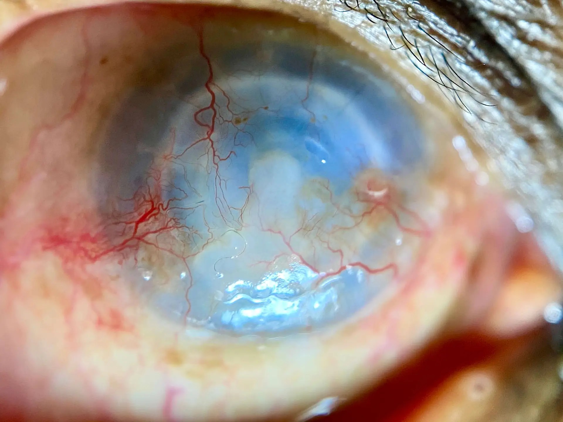 Previous Eye Surgery Repair Results