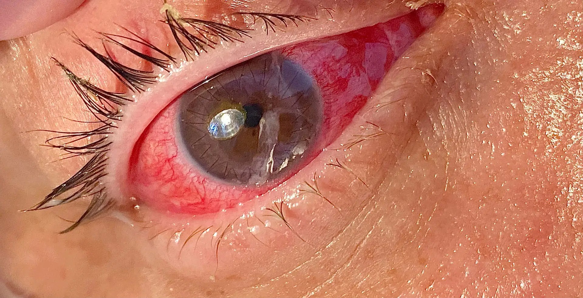 Previous Eye Surgery Repair Results