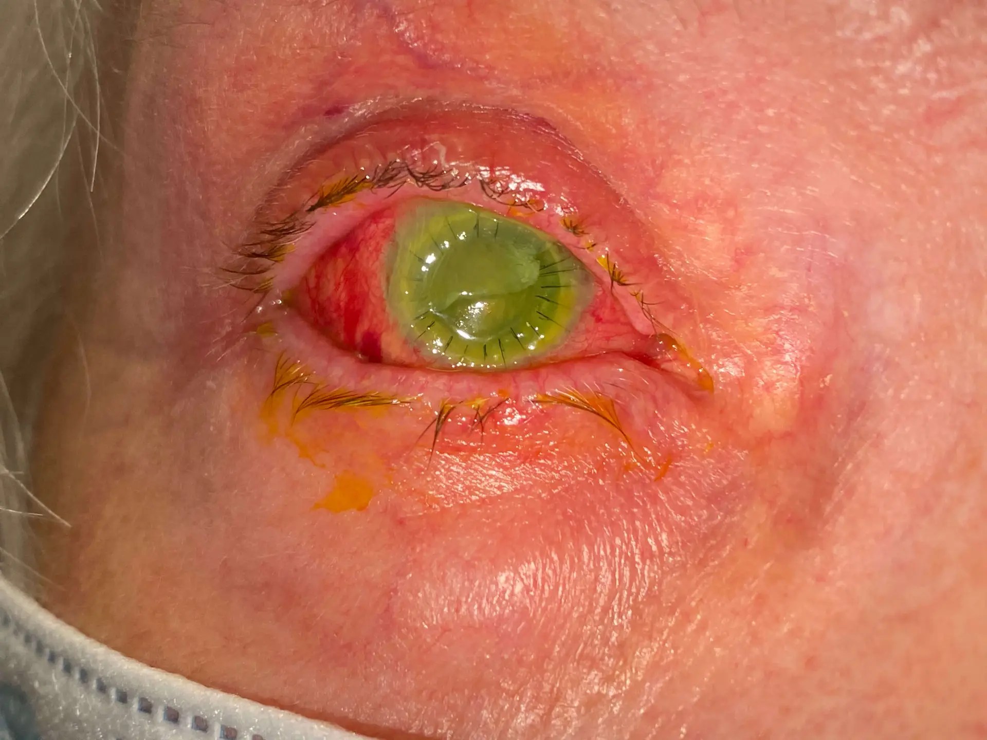 Previous Eye Surgery Repair