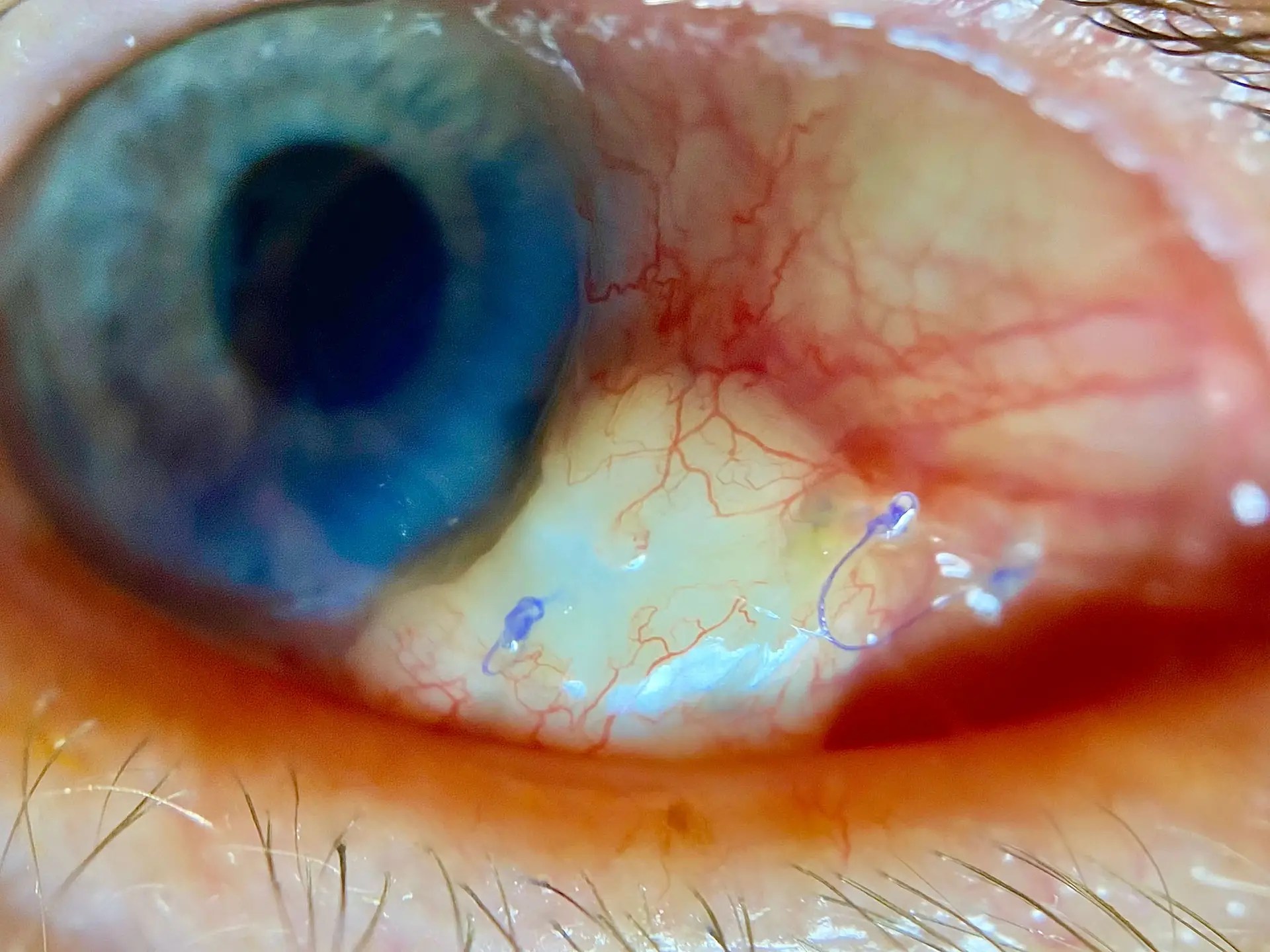 rle eye surgery woodbridge va