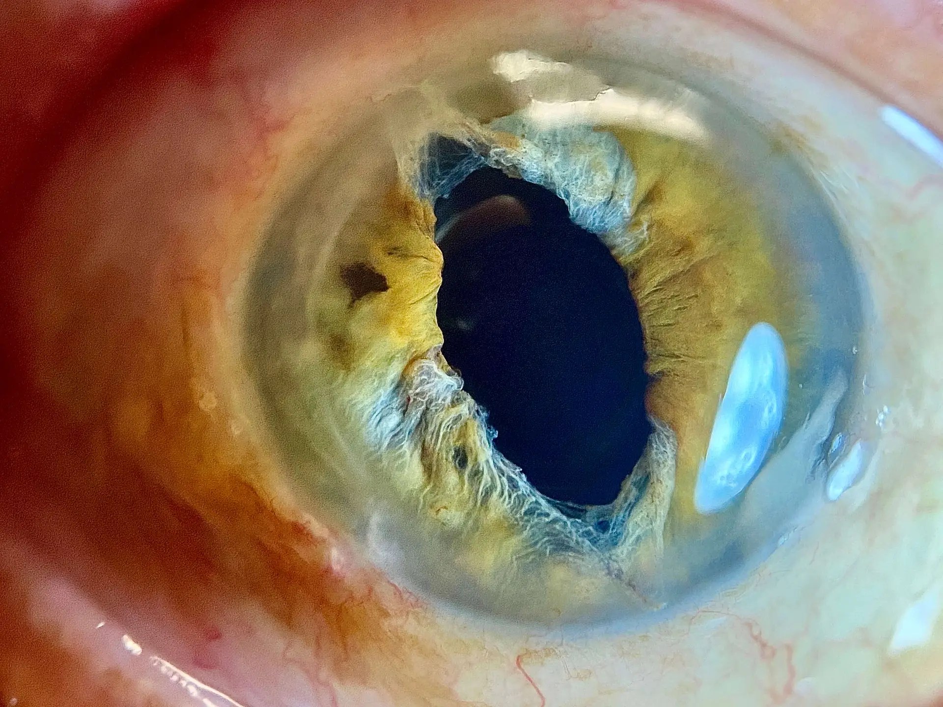 corneal transplant woodbridge va