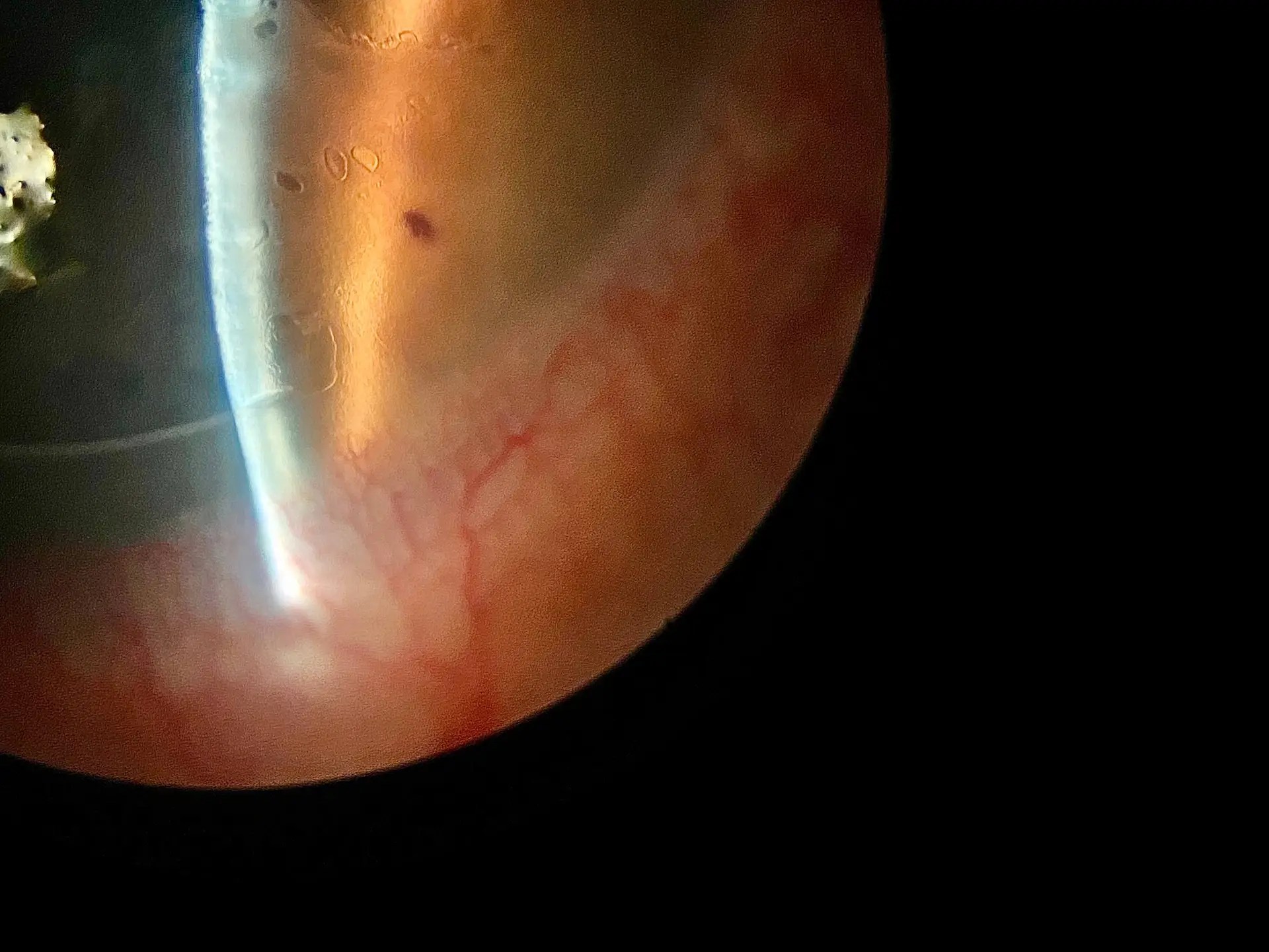 woodbridge corneal transplant