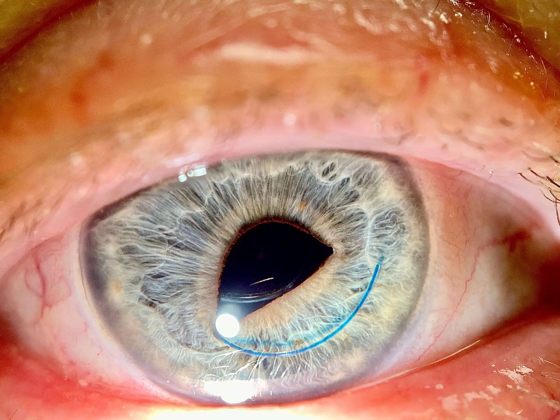 pterygium eye surgery in woodbridge