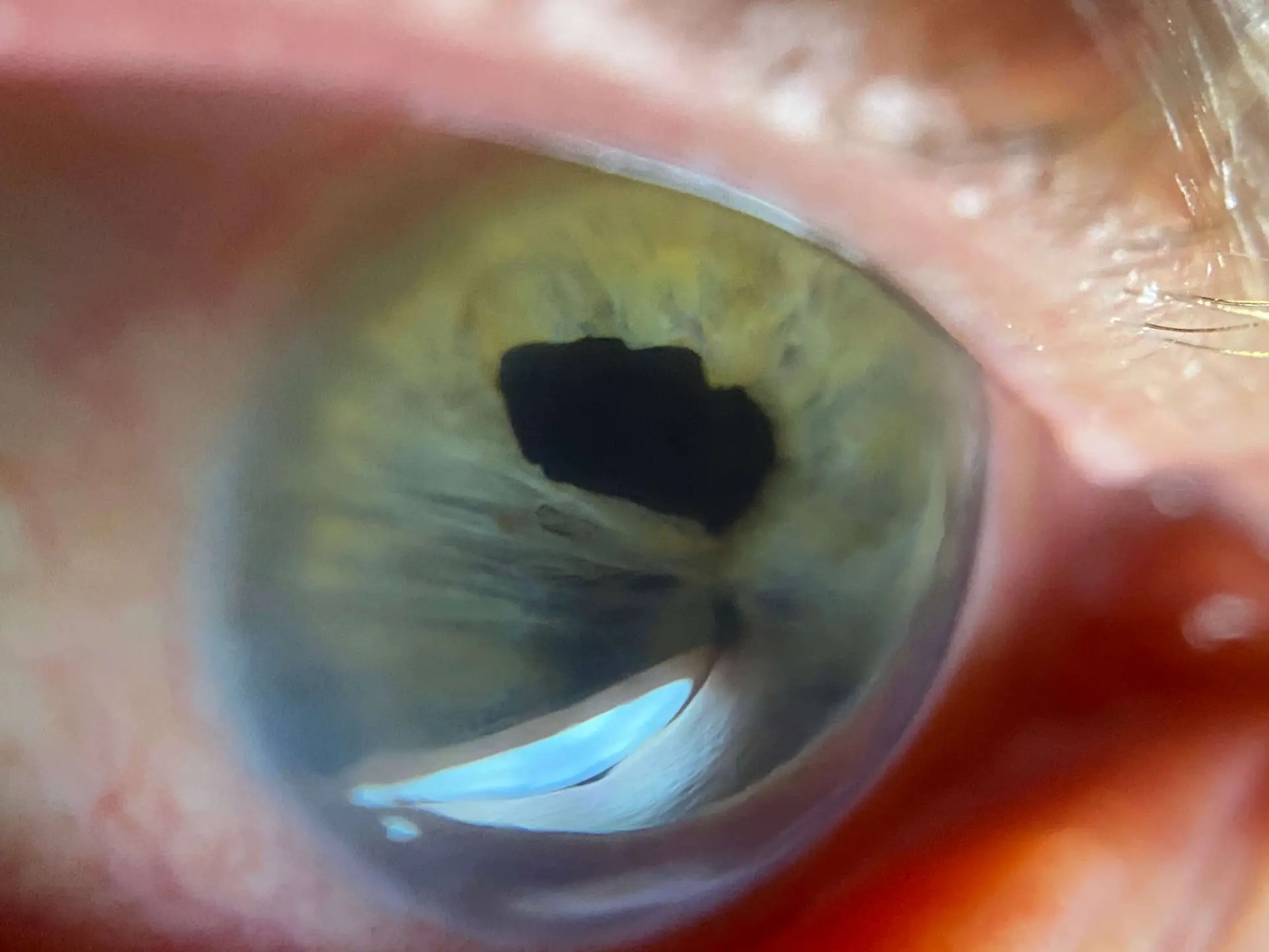 cxl eye surgery woodbridge va