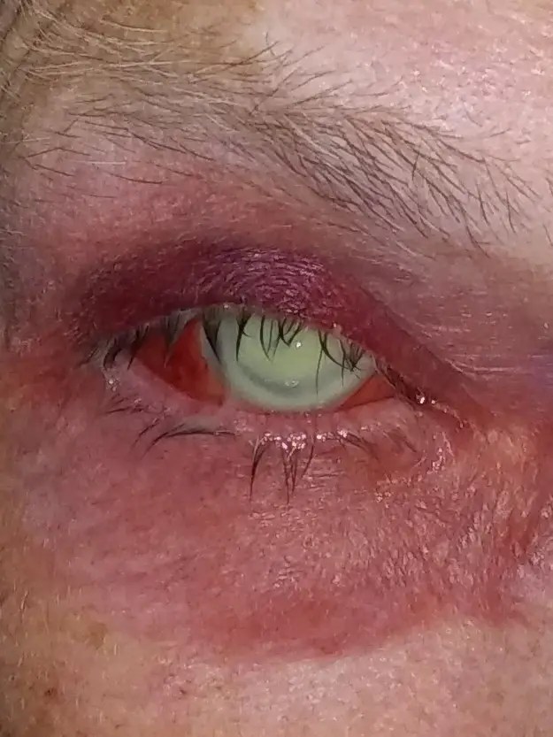 refractive cataract surgery woodbridge va