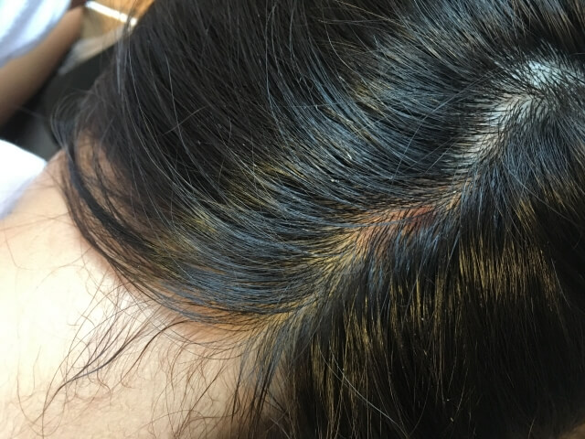 頭皮 日焼け 赤い