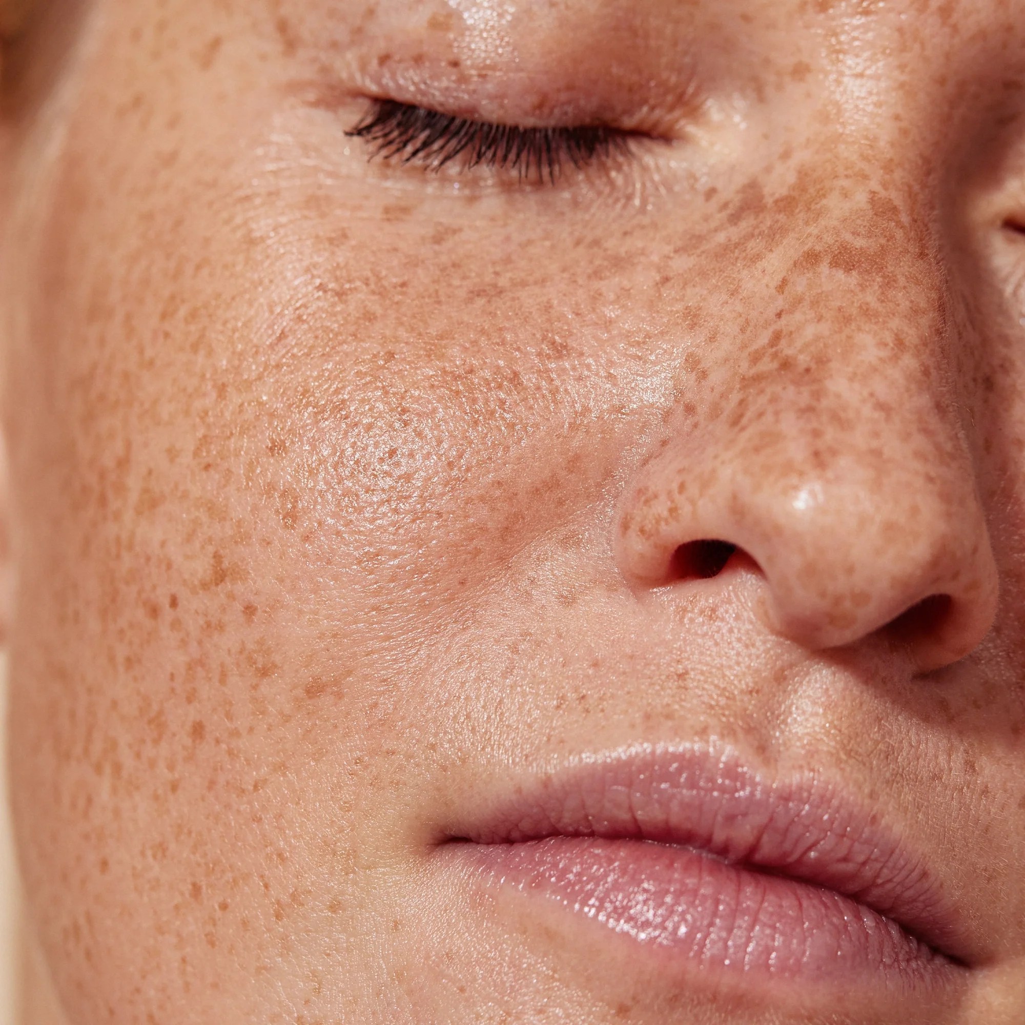 Combatting Hyperpigmentation Brighten Your Skin With The Right Routin