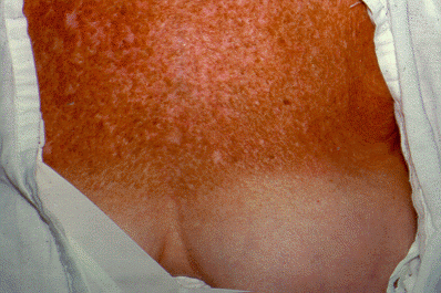 sundamage