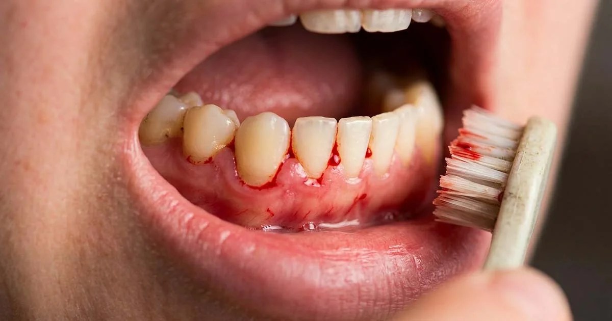 ângerarea gingiilor în timpul periajului dentar