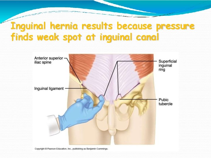 Inguinal Canal Location Formation Contents Protective Mechanism Anatomyqa The femoral hernias lie inferior and medial to the femoral vessels 3.