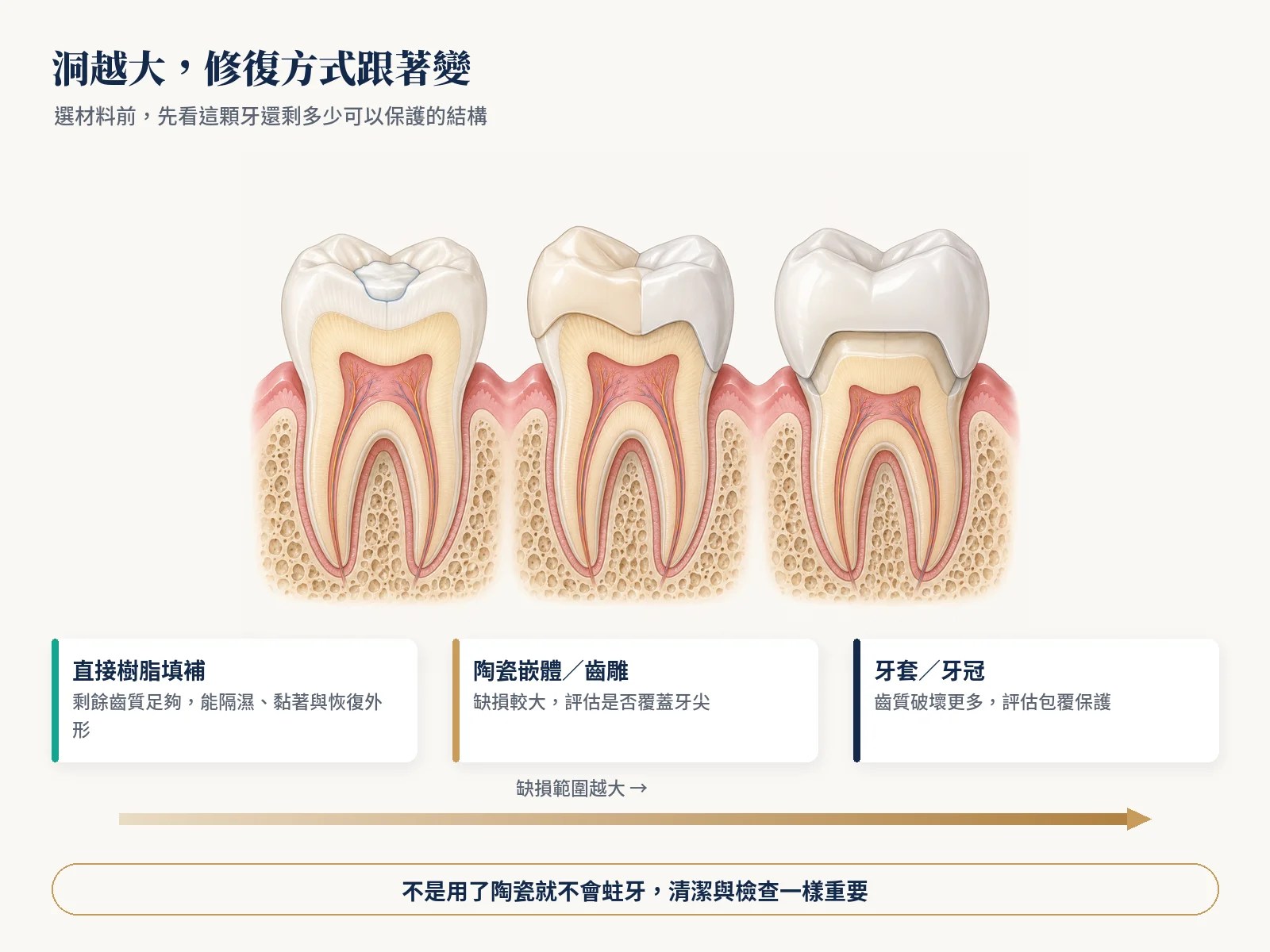 三顆臼齒剖面並排：小範圍樹脂填補、陶瓷嵌體覆蓋牙尖、全瓷牙冠包覆整顆牙