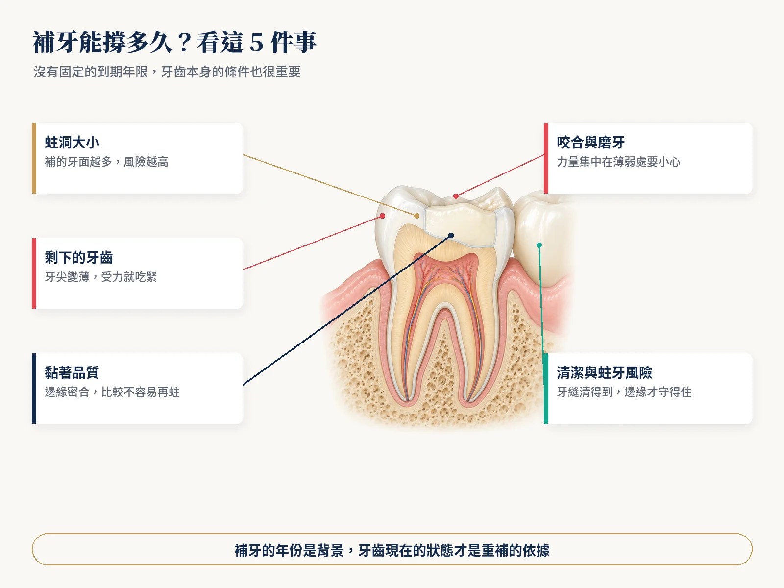 大臼齒剖面圖，標出影響樹脂補牙壽命的五個條件：蛀洞大小、剩下的牙齒、黏著品質、咬合與磨牙、清潔與蛀牙風險