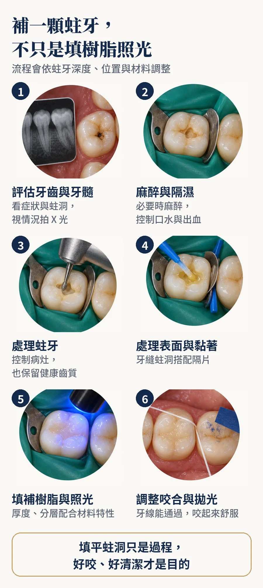 補一顆蛀牙的六個步驟插圖：評估與 X 光、麻醉與隔濕、處理蛀牙、處理表面與黏著、填補樹脂與照光、調整咬合與拋光